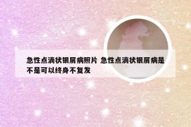 急性点滴状银屑病照片 急性点滴状银屑病是不是可以终身不复发