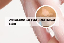 松花粉保健品能治银屑病吗 松花粉对皮肤病的功效