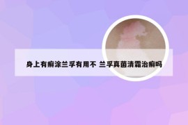 身上有癣涂兰孚有用不 兰孚真菌清霜治癣吗