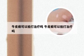 牛皮癣可以拍打治疗吗 牛皮癣可以拍打治疗吗