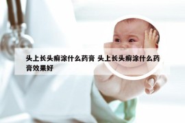 头上长头癣涂什么药膏 头上长头癣涂什么药膏效果好