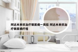 阿达木单抗治疗银屑病一周后 阿达木单抗治疗银屑病疗程