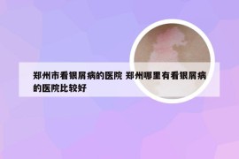 郑州市看银屑病的医院 郑州哪里有看银屑病的医院比较好