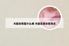 大腿白斑是什么病 大腿出现白色斑点