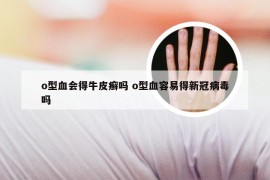 o型血会得牛皮癣吗 o型血容易得新冠病毒吗