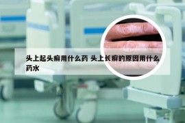 头上起头癣用什么药 头上长癣的原因用什么药水