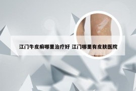 江门牛皮癣哪里治疗好 江门哪里有皮肤医院