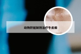 动物肝脏制剂治疗牛皮癣