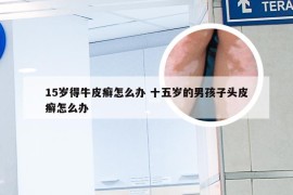 15岁得牛皮癣怎么办 十五岁的男孩子头皮癣怎么办
