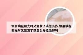 银屑病在照光时又复发了该怎么办 银屑病在照光时又复发了该怎么办能治好吗