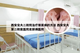 西安交大二附院治疗银屑病的方法 西安交大第二附属医院皮肤病医院