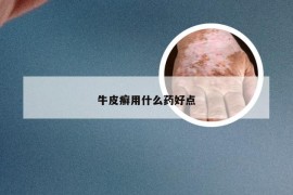 牛皮癣用什么药好点