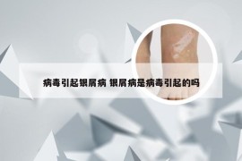 病毒引起银屑病 银屑病是病毒引起的吗