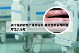 两个胳膊肘关节处对称癣 胳膊肘关节对称湿疹怎么治疗