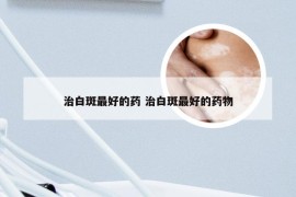 治白斑最好的药 治白斑最好的药物