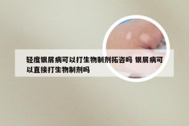 轻度银屑病可以打生物制剂拓咨吗 银屑病可以直接打生物制剂吗