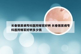 长春银屑病专科医院哪家好啊 长春银屑病专科医院哪家好啊多少钱