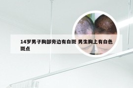 14岁男子胸部旁边有白斑 男生胸上有白色斑点