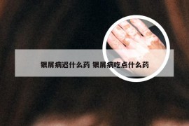 银屑病迟什么药 银屑病吃点什么药