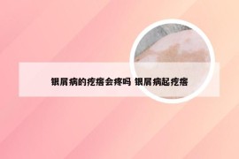银屑病的疙瘩会疼吗 银屑病起疙瘩