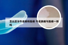 怎么区分牛皮癣和股癣 牛皮肤癣与股癣一样吗