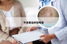 牛皮癣治好后喝酒