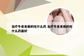 治疗牛皮皮癣的吃什么药 治疗牛皮皮癣的吃什么药最好