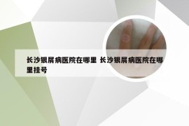 长沙银屑病医院在哪里 长沙银屑病医院在哪里挂号