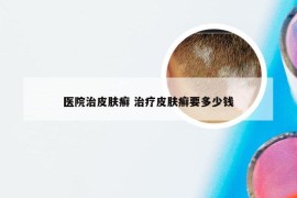 医院治皮肤癣 治疗皮肤癣要多少钱