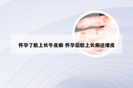 怀孕了脸上长牛皮癣 怀孕后脸上长癣还爆皮