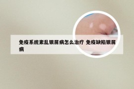 免疫系统紊乱银屑病怎么治疗 免疫缺陷银屑病