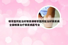 哪家医院能治好银屑病哪家医院能治好银屑病 全国哪里治疗银屑病最专业