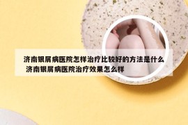 济南银屑病医院怎样治疗比较好的方法是什么 济南银屑病医院治疗效果怎么样