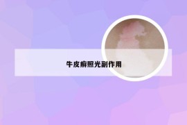 牛皮癣照光副作用