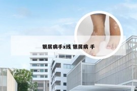 银屑病手x线 银屑病 手