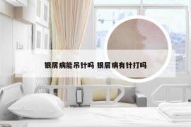 银屑病能吊针吗 银屑病有针打吗