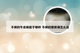 不痒的牛皮癣属于哪种 不痒的银屑病怎么治