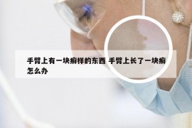 手臂上有一块癣样的东西 手臂上长了一块癣怎么办