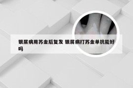银屑病用苏金后复发 银屑病打苏金单抗能好吗
