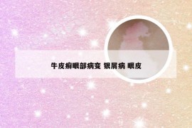 牛皮癣眼部病变 银屑病 眼皮