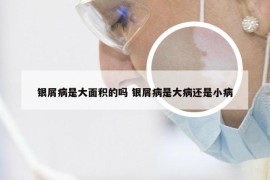 银屑病是大面积的吗 银屑病是大病还是小病
