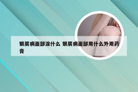 银屑病面部涂什么 银屑病面部用什么外用药膏