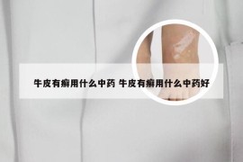 牛皮有癣用什么中药 牛皮有癣用什么中药好