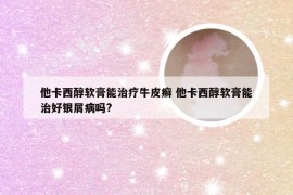 他卡西醇软膏能治疗牛皮癣 他卡西醇软膏能治好银屑病吗?