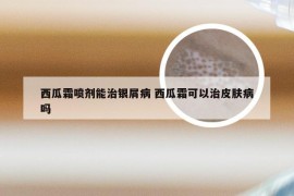 西瓜霜喷剂能治银屑病 西瓜霜可以治皮肤病吗