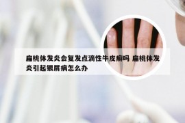 扁桃体发炎会复发点滴性牛皮癣吗 扁桃体发炎引起银屑病怎么办
