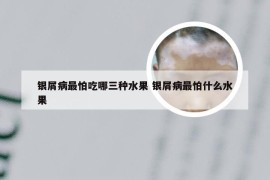 银屑病最怕吃哪三种水果 银屑病最怕什么水果