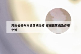 河南省郑州市银屑病治疗 郑州银屑病治疗哪个好