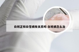 白班正和白雪病有关系吗 白班病怎么治