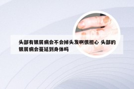 头部有银屑病会不会掉头发啊很担心 头部的银屑病会蔓延到身体吗